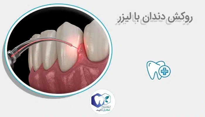 روکش دندان با لیزر