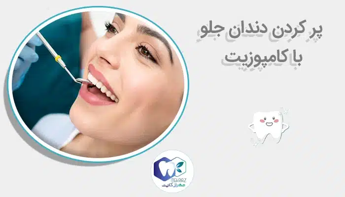 پر کردن دندان جلو با کامپوزیت
