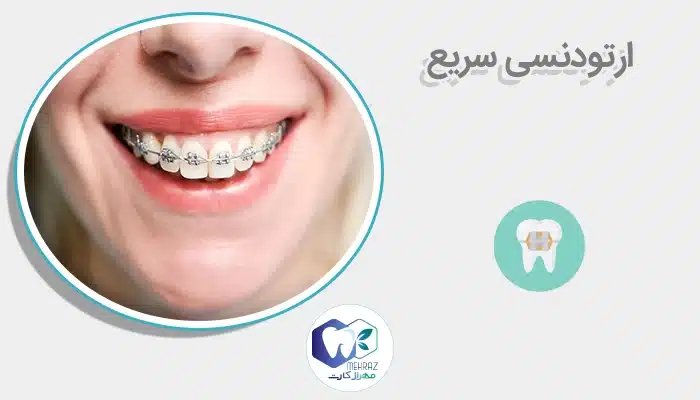 ارتودنسی سریع
