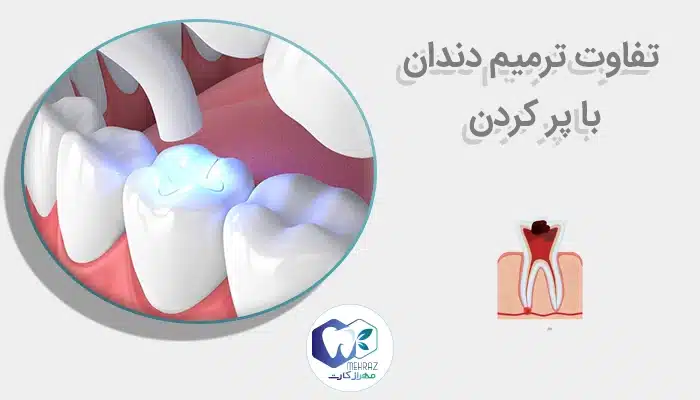 تفاوت ترمیم دندان با پر کردن