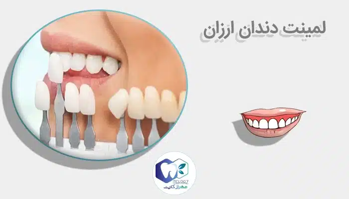 لمینت دندان ارزان