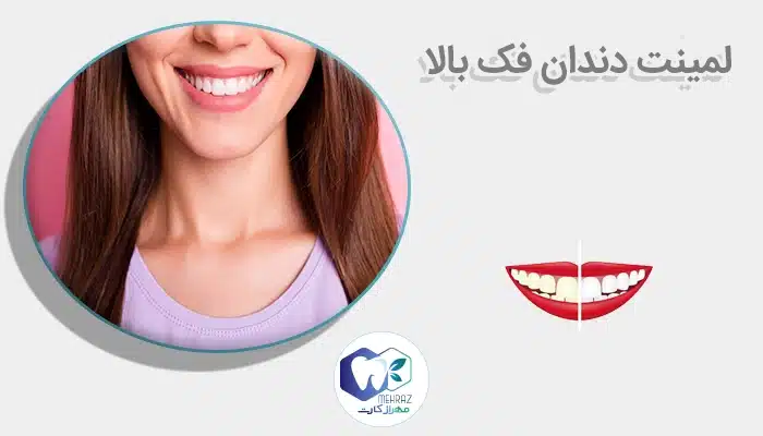 لمینت دندان فک بالا