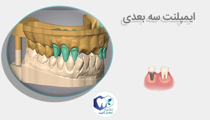 ایمپلنت سه بعدی