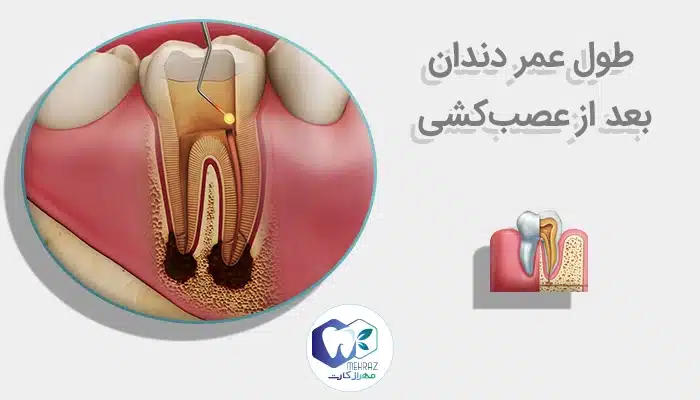 طول عمر دندان بعد از عصبکشی