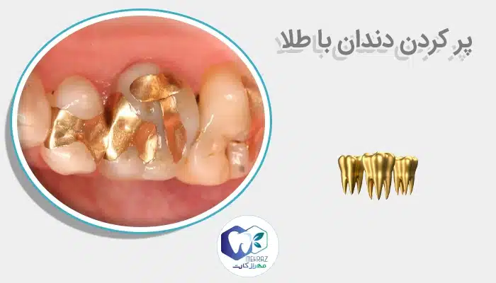 پر کردن دندان با طلا