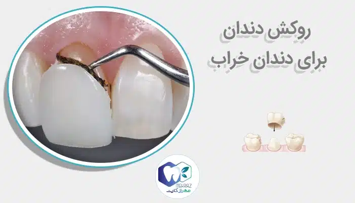 روکش دندان برای دندان خراب