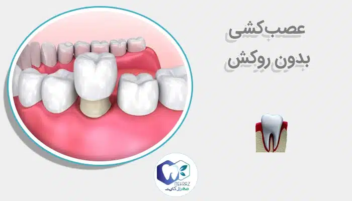 عصبکشی بدون روکش