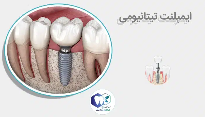 ایمپلنت تیتانیومی