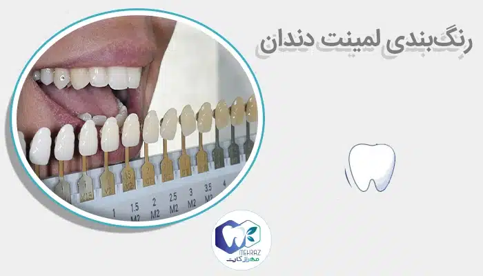 رنگبندی لمینت دندان