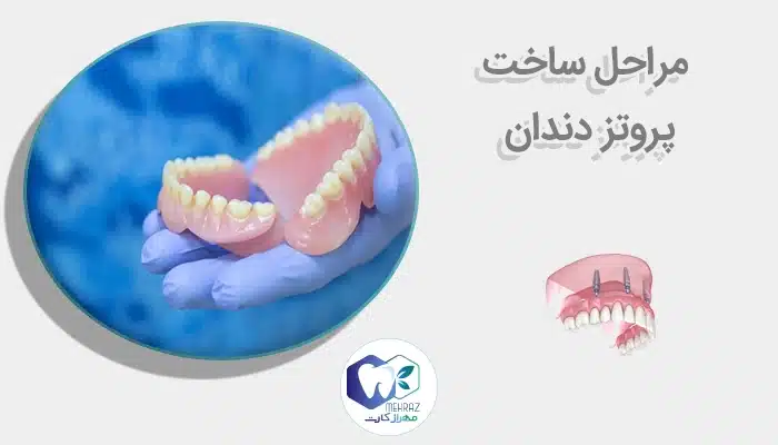 مراحل ساخت پروتز دندان