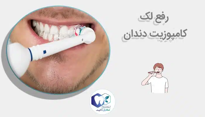 رفع لک کامپوزیت دندان