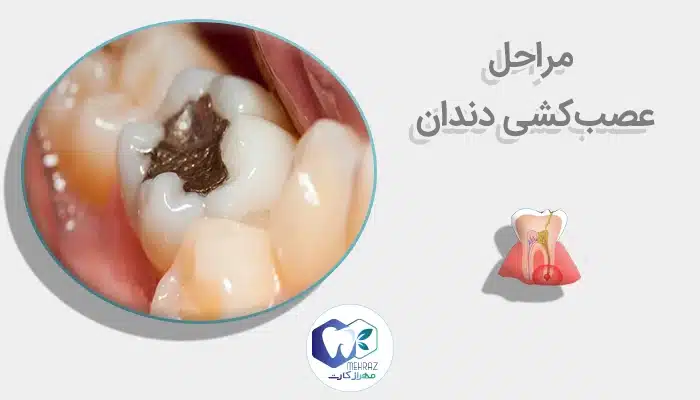 مراحل عصبکشی دندان