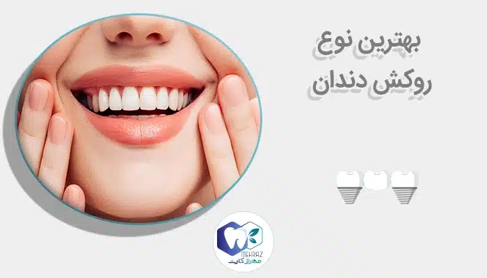 بهترین نوع روکش دندان