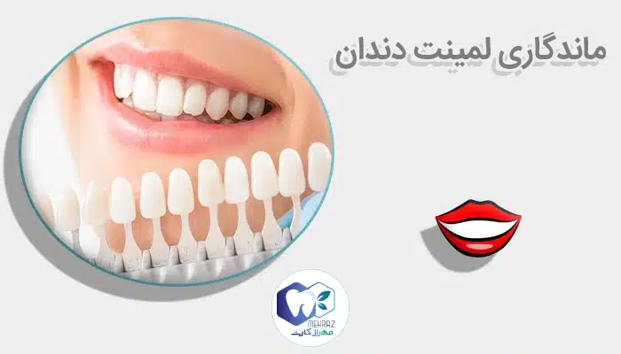 ماندگاری لمینت دندان