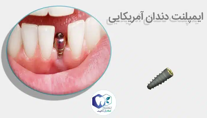 ایمپلنت دندان آمریکایی