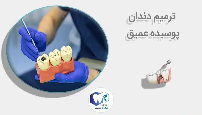 ترمیم دندان پوسیده عمیق