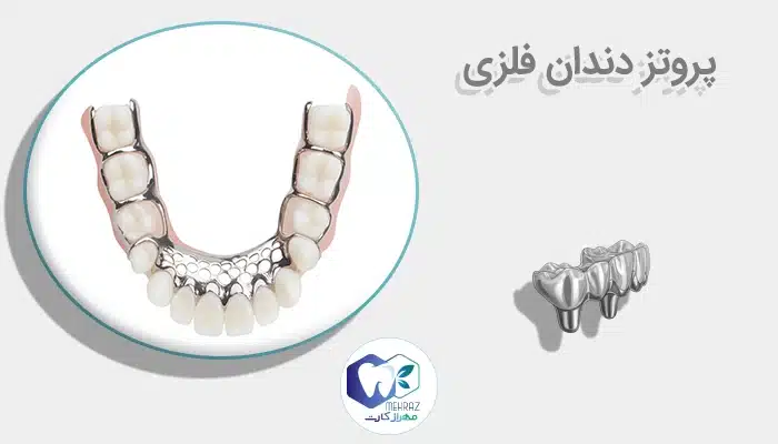 پروتز دندان فلزی