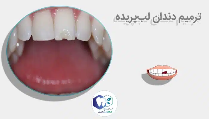 ترمیم دندان لبپریده