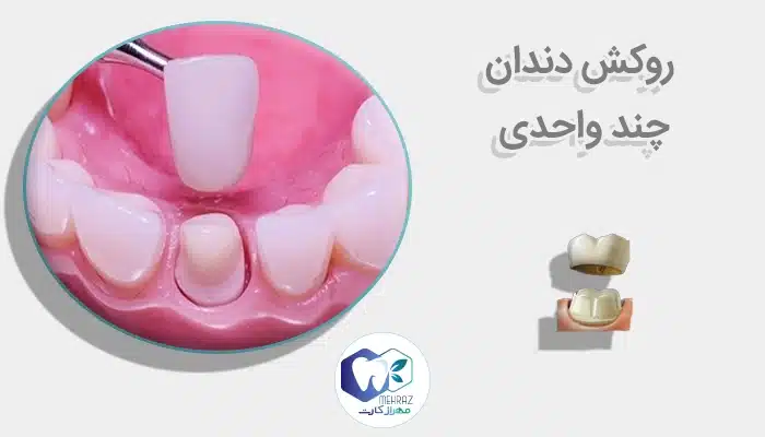 روکش دندان چند واحدی