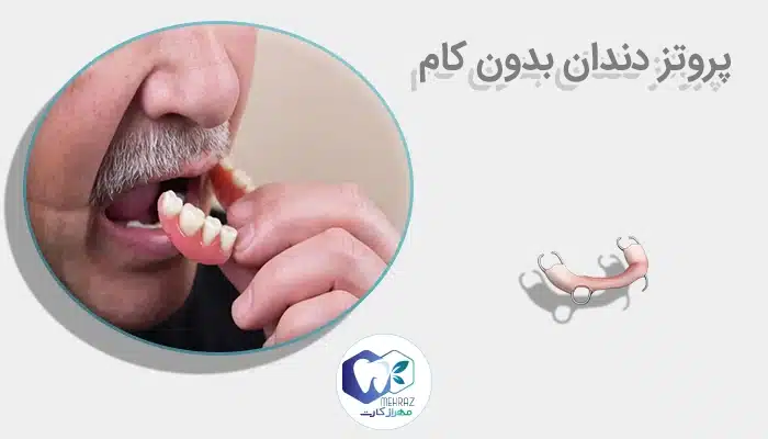 پروتز دندان بدون کام