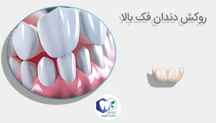 روکش دندان فک بالا