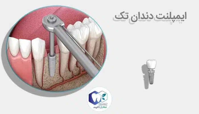 ایمپلنت دندان تک