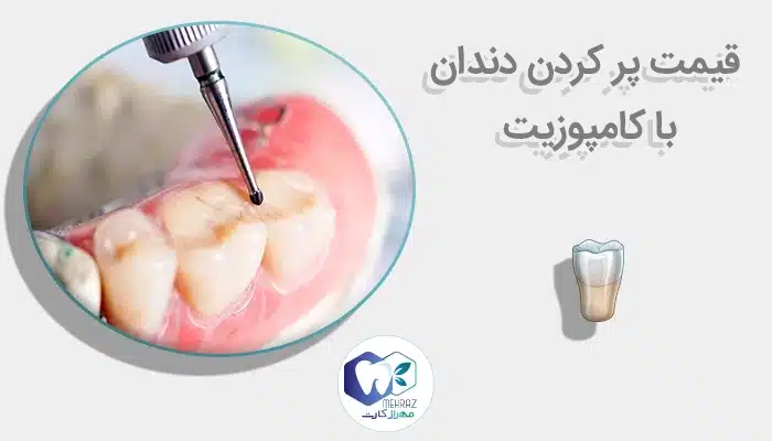 قیمت پر کردن دندان با کامپوزیت