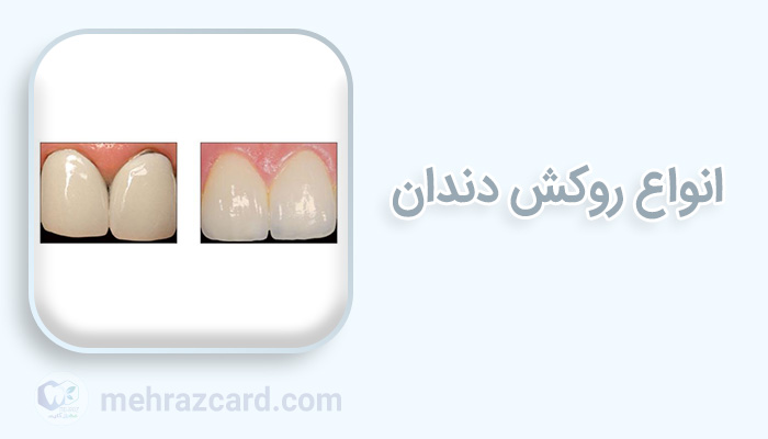 انواع روکش دندان | قیمت روکش دندان