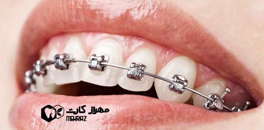 براکت ارتودنسی | انواع