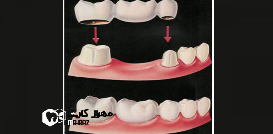 بریج دندان