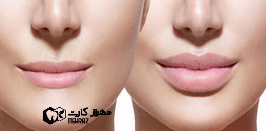 تزریق ژل لب | تخفیف،هزینه