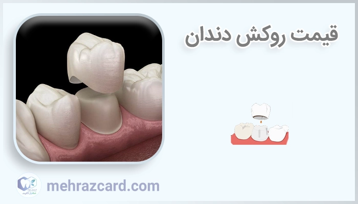 قیمت روکش دندان