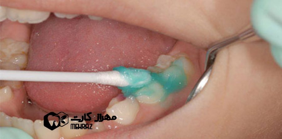 فلورایدتراپی کودکان
