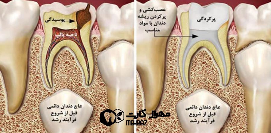 درمان ریشه