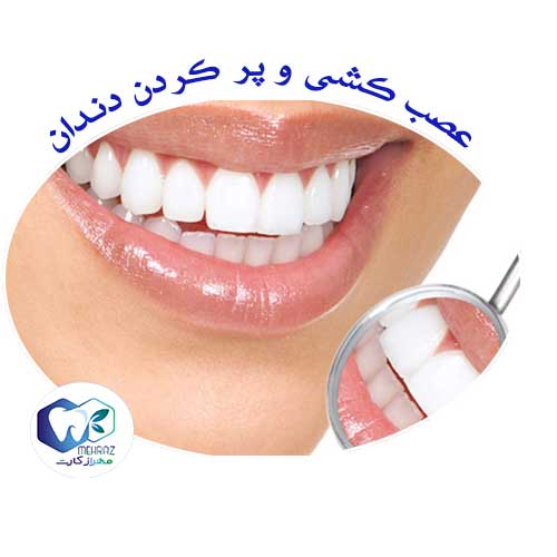 هزینه عصب کشی و پر کردن ✅ ایمپلنت دندان سال ۹۹