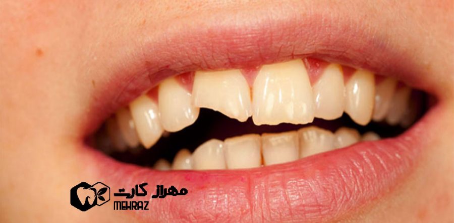 شکستگی دندان | انواع و درمان