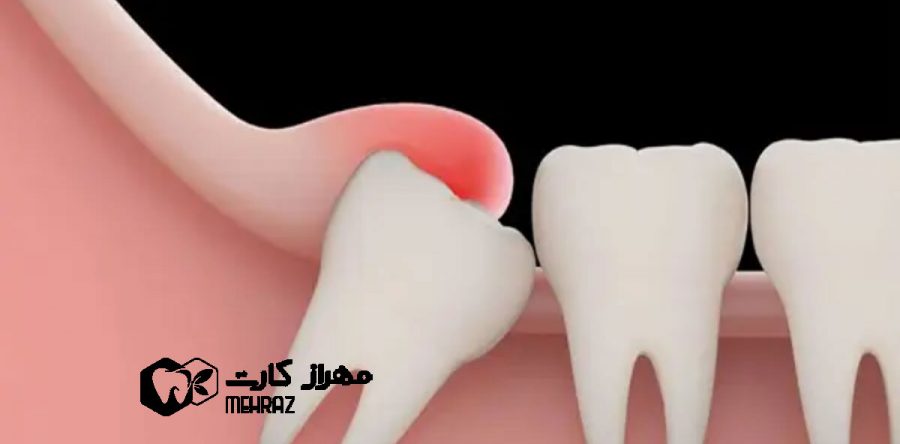 کشیدن دندان عقل | مزایا و معایب