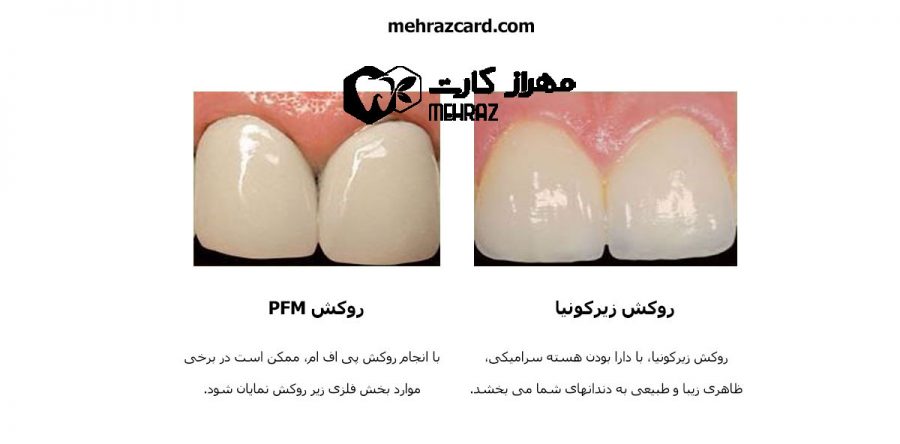 روکش دندان ✅ قیمت روکش دندان