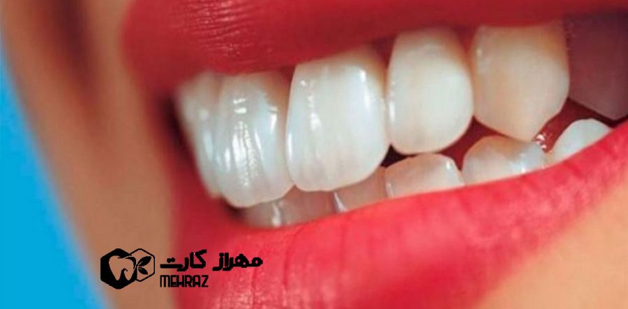 ونیر کامپوزیت روی روکش