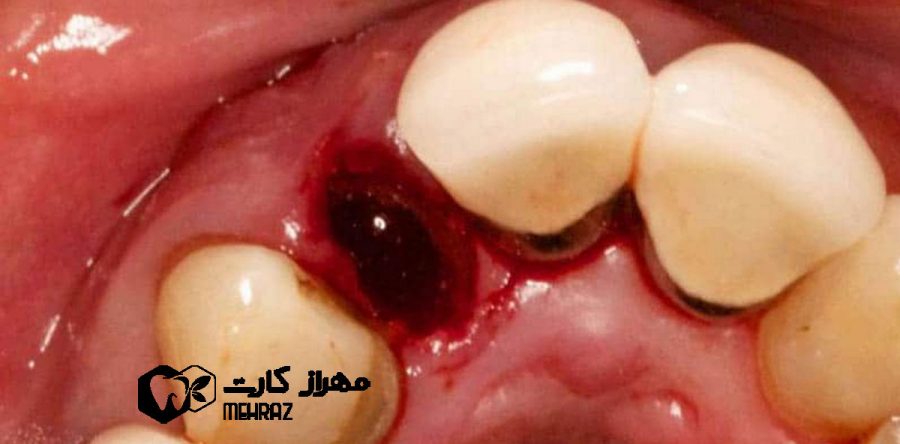 حفره خشک | علائم و پیشگیری