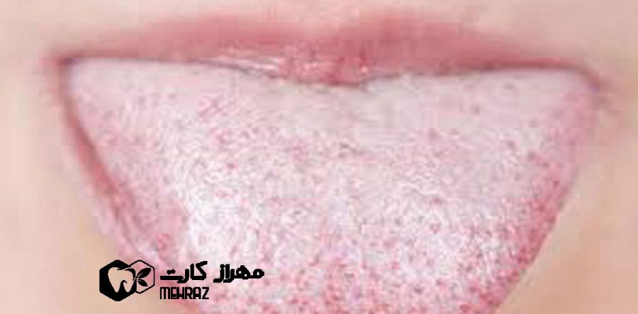 زبان سفید | عوامل،پیشگیری