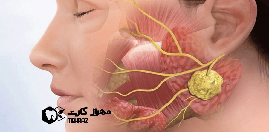 افزایش ریسک ابتلا به سرطان غدد بزاقی (پاروتید) در استفاده از موبایل