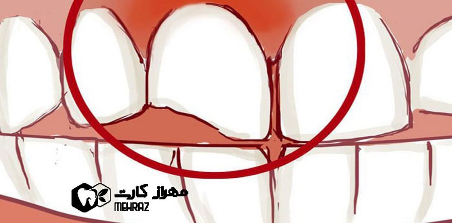 شکستگی دندان ها | لب پریدگی