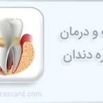 پیوره دندان