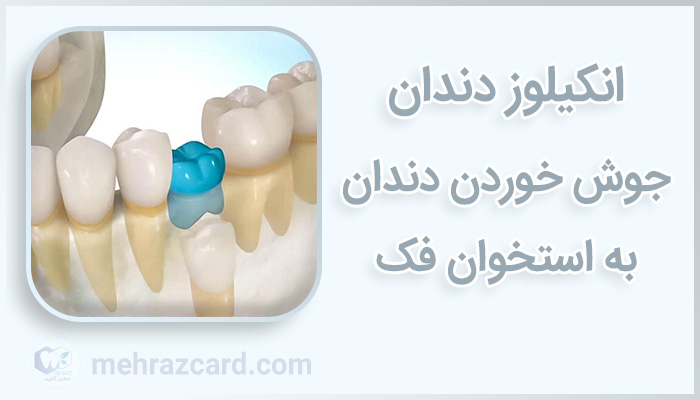 انکیلوز دندان