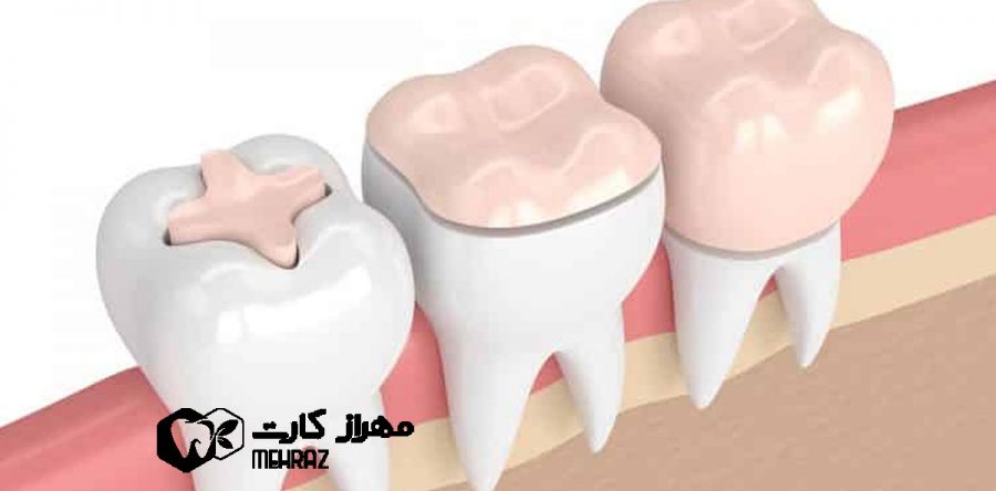 تاج گذاشتن روی دندان | انواع،کاربرد
