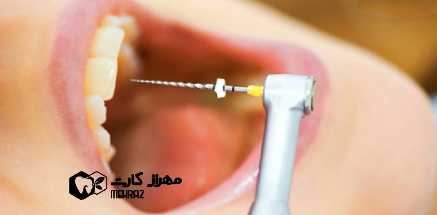نکروز دندان | مرگ دندان