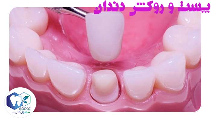 پست-و-روکش-دندان
