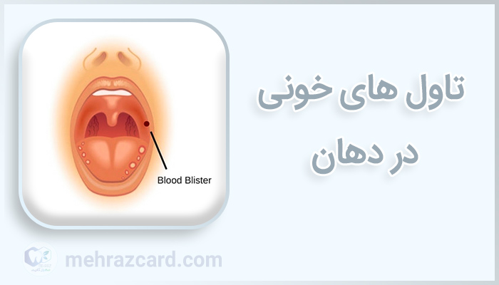 تاول های خونی در دهان