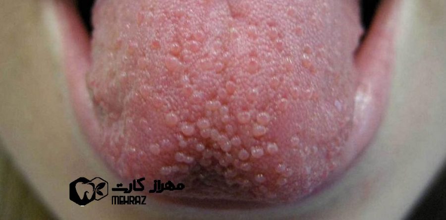 تورم جوانه های چشایی زبان | دلایل